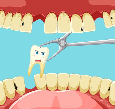 Tooth Extraction Image