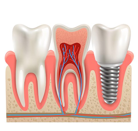 Dental Implant Treatment at Earth Dental Hospital