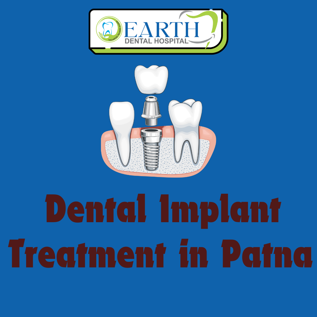 Dental Implant Treatment in Patna